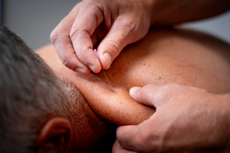 Dry needling